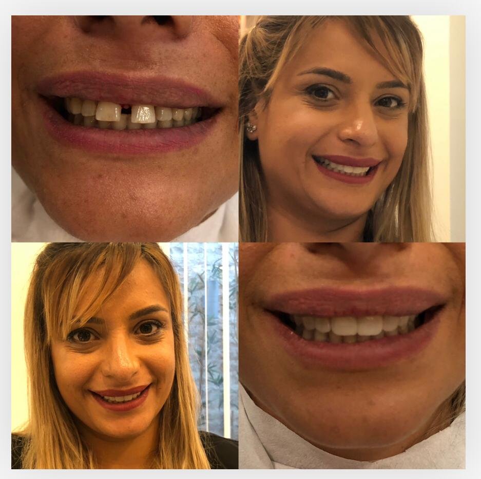 Dental veneers before after Turkey — Smile transformation