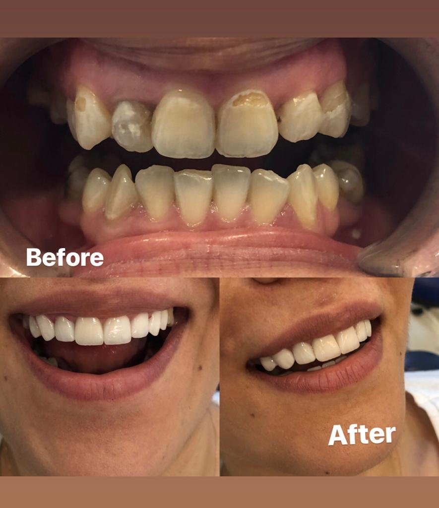 Smile makeover Turkey — Porcelain veneers result