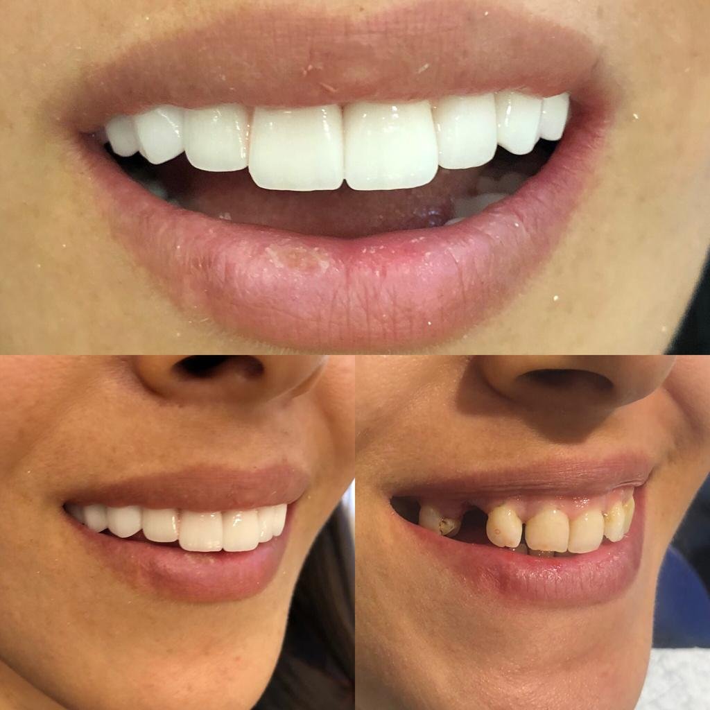 Dental crowns Turkey — Before and after crown restoration