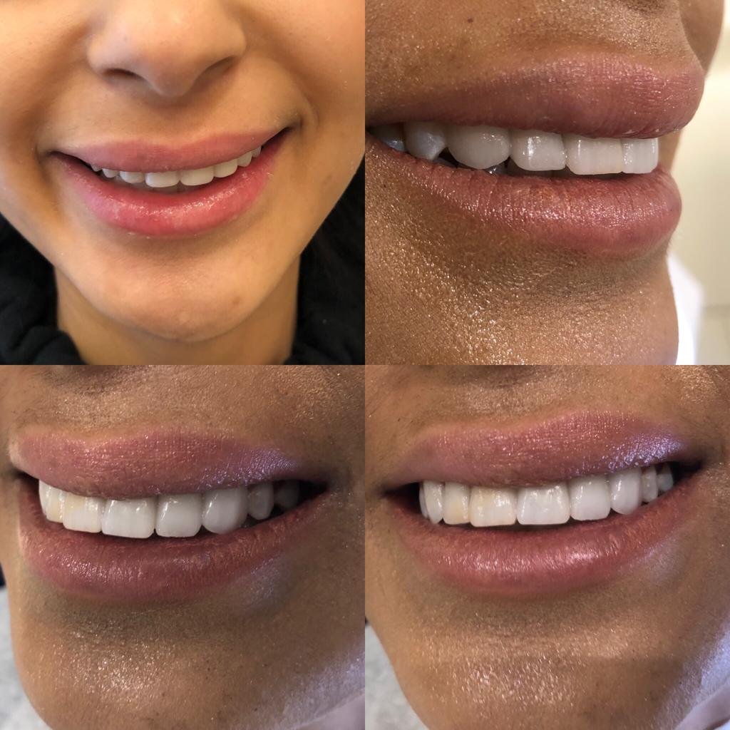 Full mouth makeover Turkey — Complete dental transformation