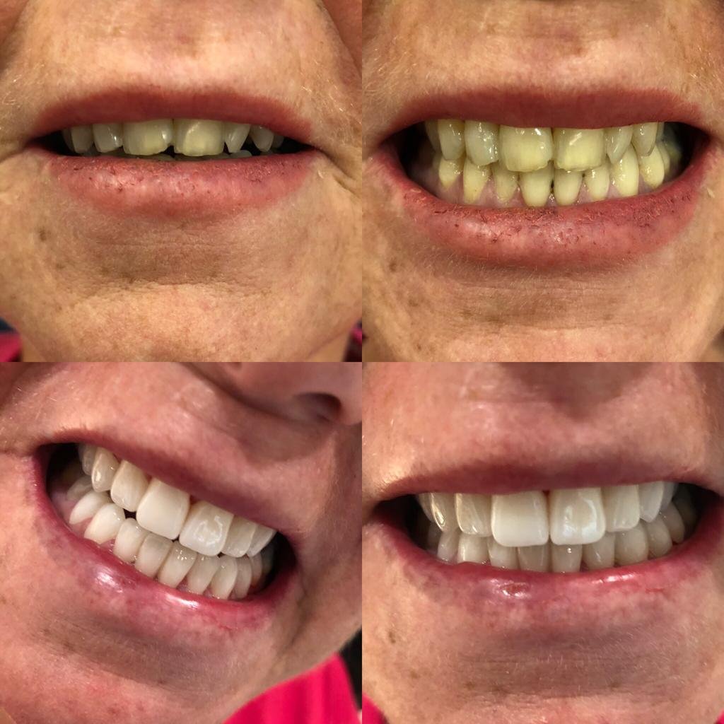 Hollywood Smile veneers Turkey — Patient smile close-up