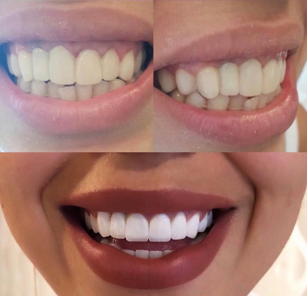 Teeth whitening Turkey — Professional laser whitening result