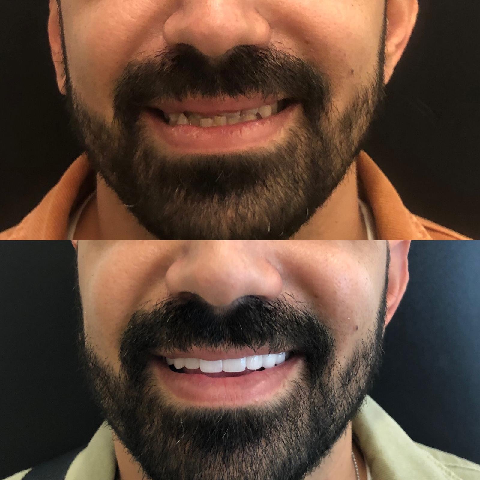 Dental implants Turkey — Before after implant treatment