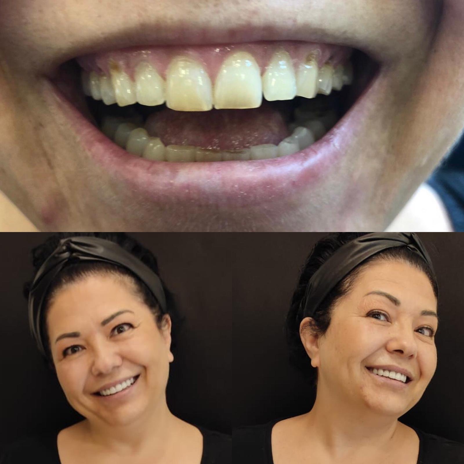Smile transformation Turkey — Happy patient after dental treatment