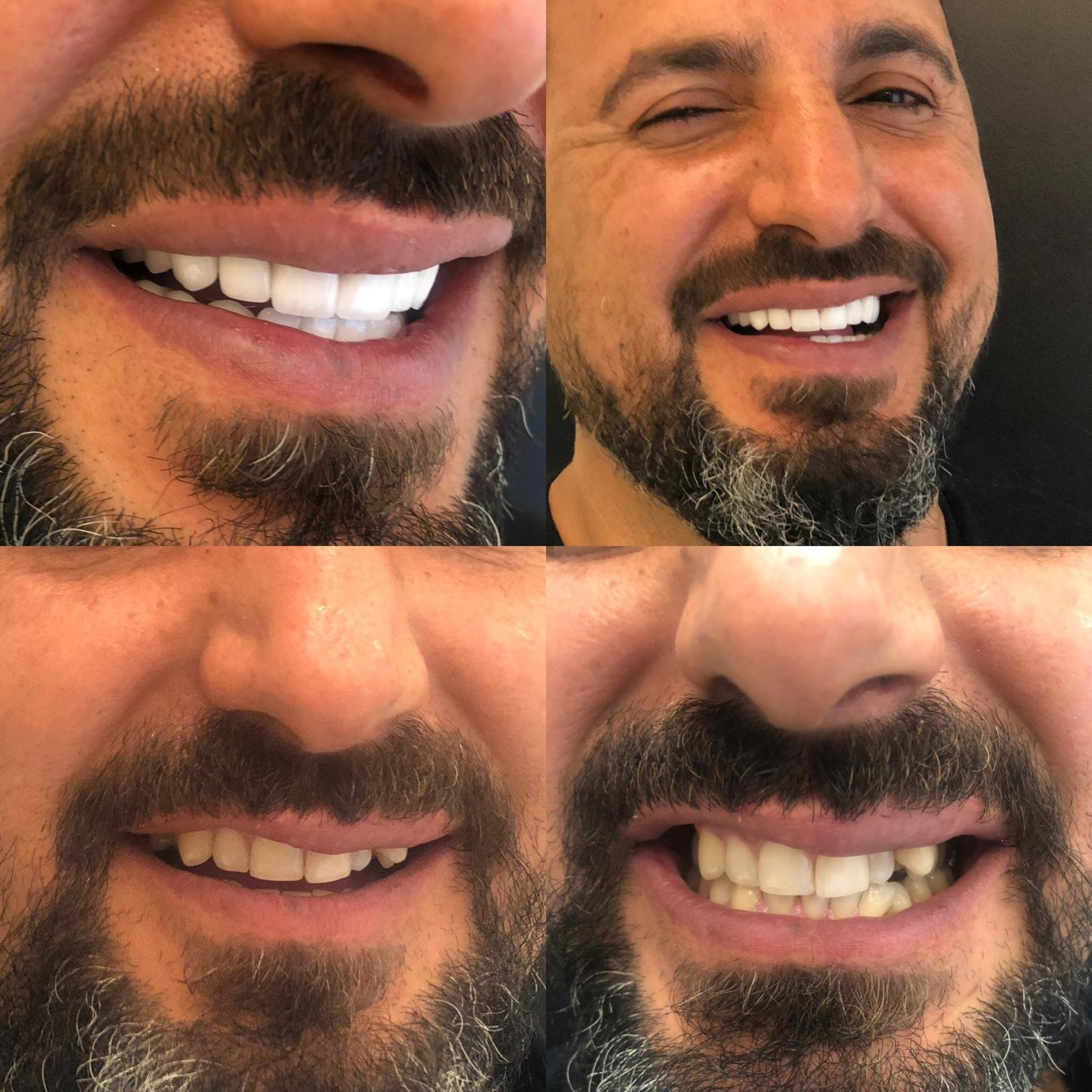 Hollywood Smile Turkey result — Patient before and after veneers